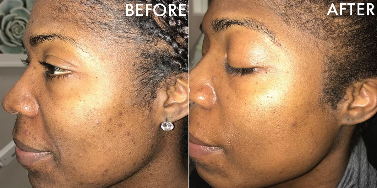 Peeling Serum